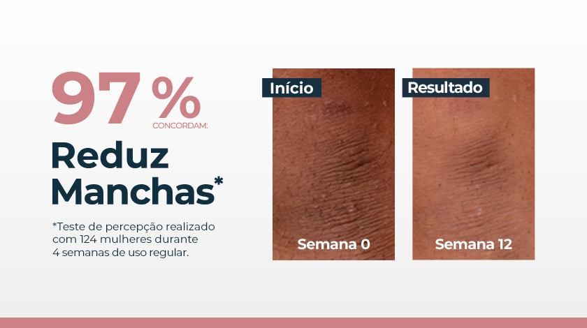 Comparativo de fotos de pele com manchas: à esquerda, pele com manchas visíveis antes do tratamento; à direita, pele mais uniforme após o uso do produto. Fundo claro com destaque para o percentual de eficácia.
